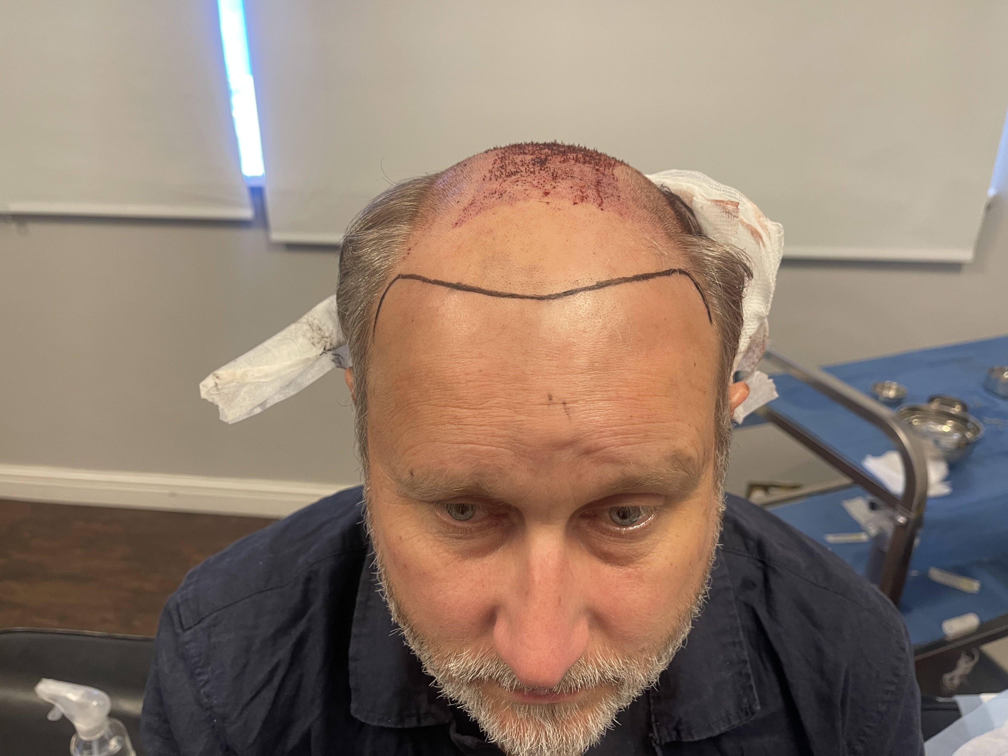 Colin Norwood 7 hair transplant 6-month results